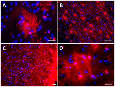 Deciphering the Astrocyte Reaction in Alzheimer’s Disease